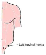 Inguinal Hernia